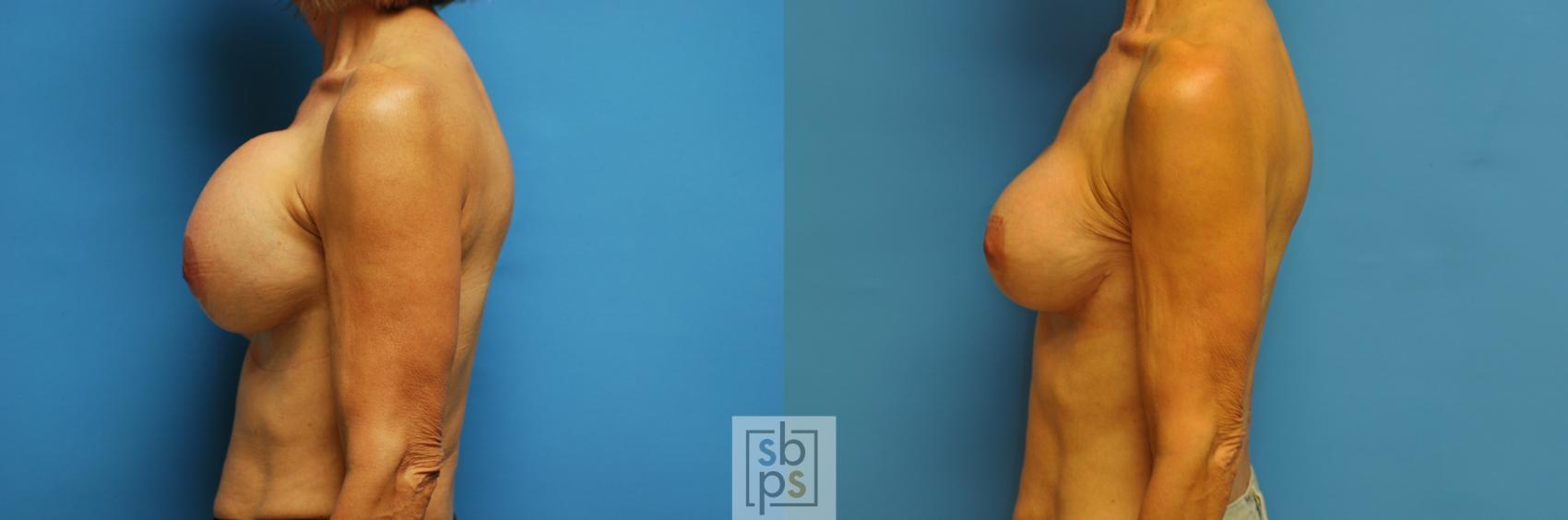 Before & After Breast Augmentation Case 103 View #3 View in Torrance & Los Angeles, CA, CA