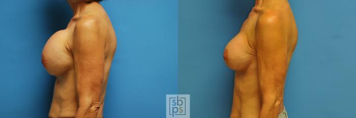 Before & After Breast Augmentation Case 103 View #3 View in Torrance, CA
