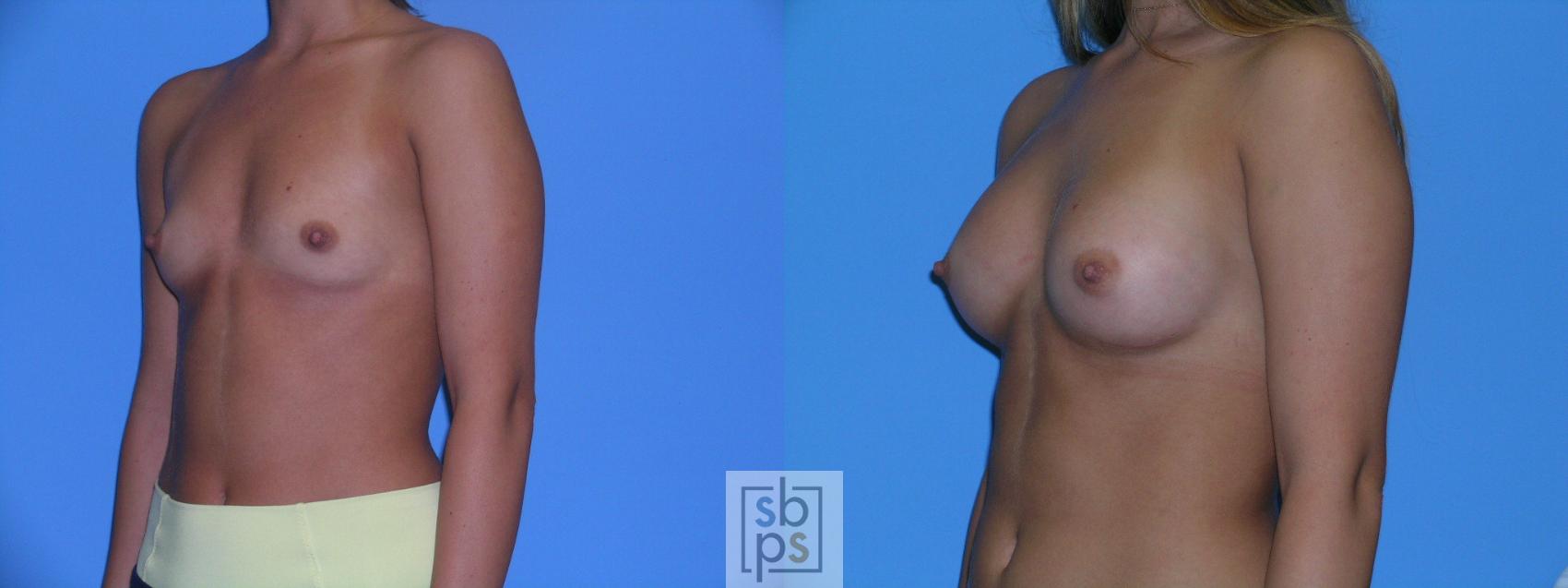 Before & After Breast Augmentation Case 112 View #1 View in Torrance, CA