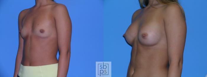 Before & After Breast Augmentation Case 112 View #1 View in Torrance, CA