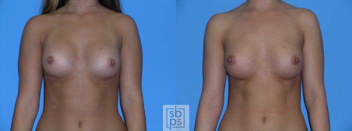 Before & After Breast Augmentation Case 112 View #2 View in Torrance, CA