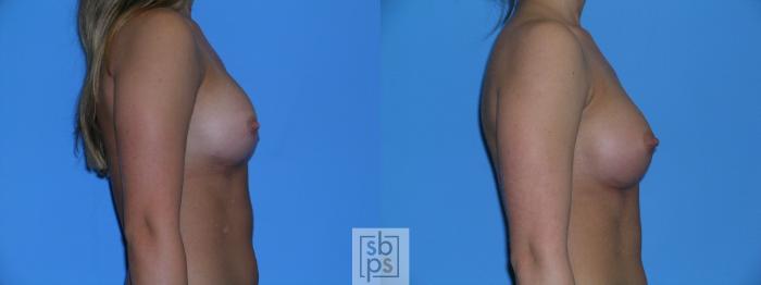 Before & After Breast Augmentation Case 112 View #3 View in Torrance, CA