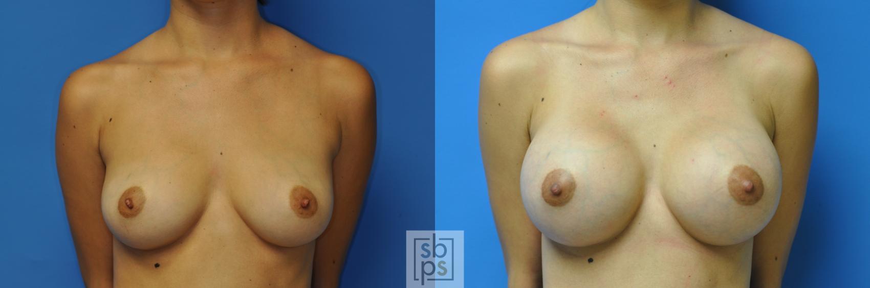 Before & After Breast Augmentation Case 113 View #1 View in Torrance, CA