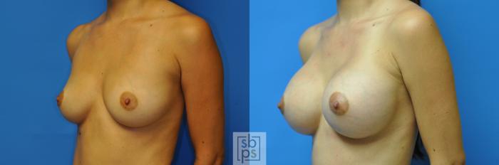 Before & After Breast Augmentation Case 113 View #2 View in Torrance, CA