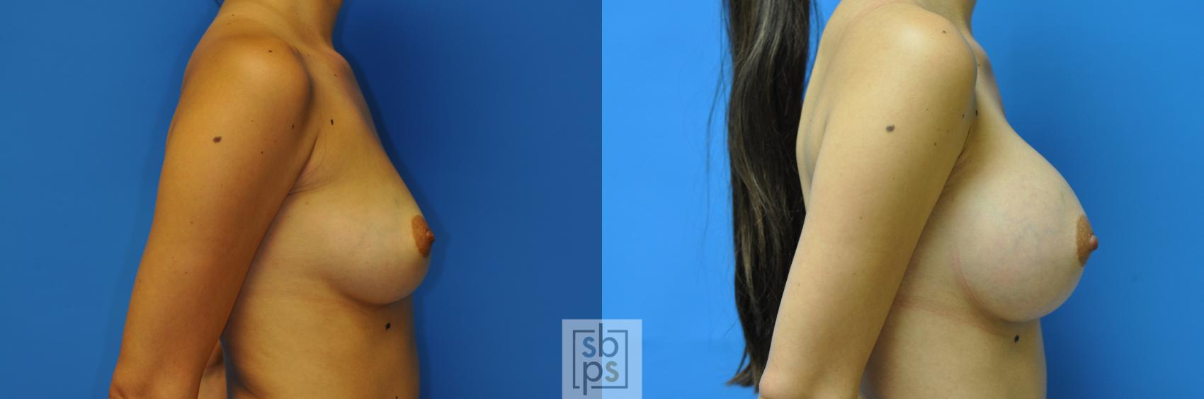 Before & After Breast Augmentation Case 113 View #3 View in Torrance & Los Angeles, CA, CA