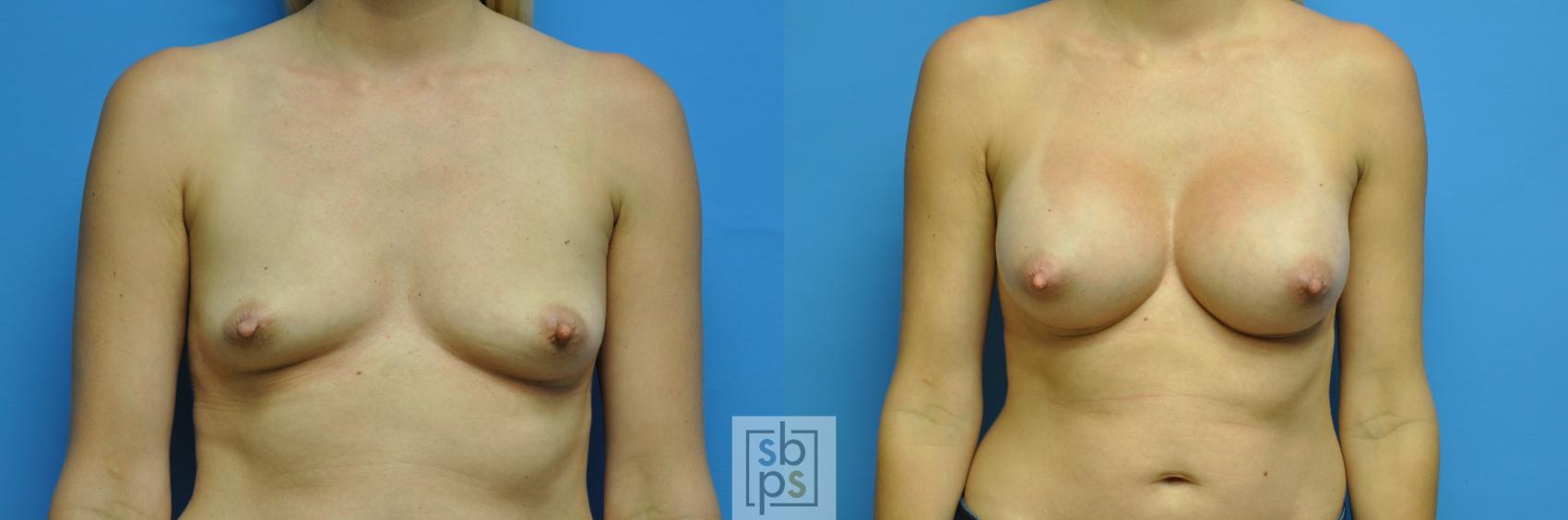 Before & After Breast Augmentation Case 115 View #1 View in Torrance, CA