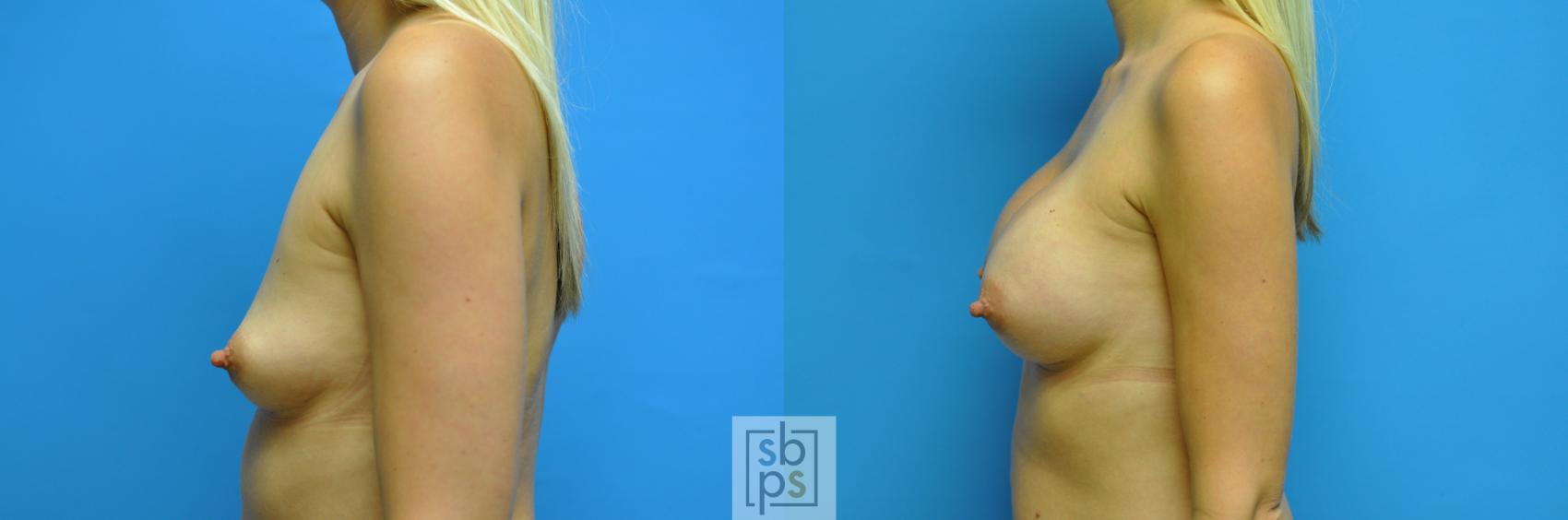Before & After Breast Augmentation Case 115 View #2 View in Torrance & Los Angeles, CA, CA