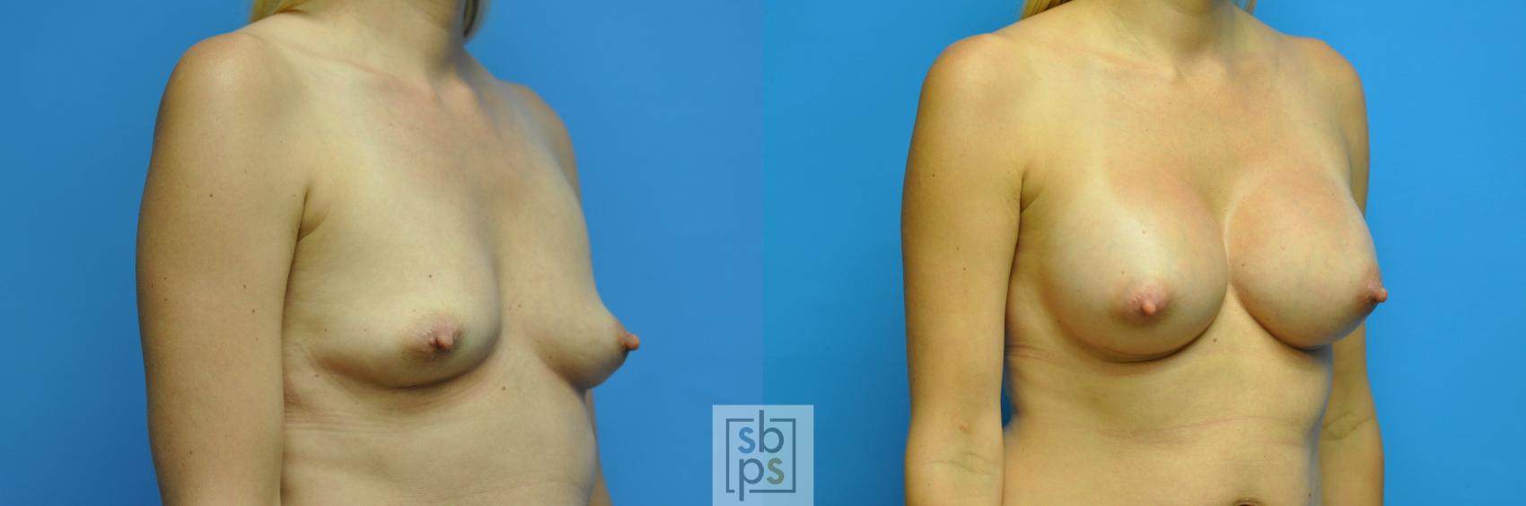 Before & After Breast Augmentation Case 115 View #3 View in Torrance & Los Angeles, CA, CA
