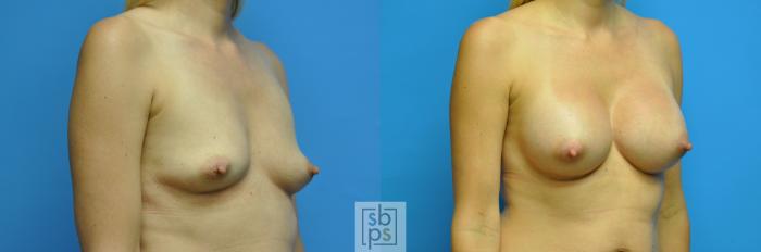 Before & After Breast Augmentation Case 115 View #3 View in Torrance, CA