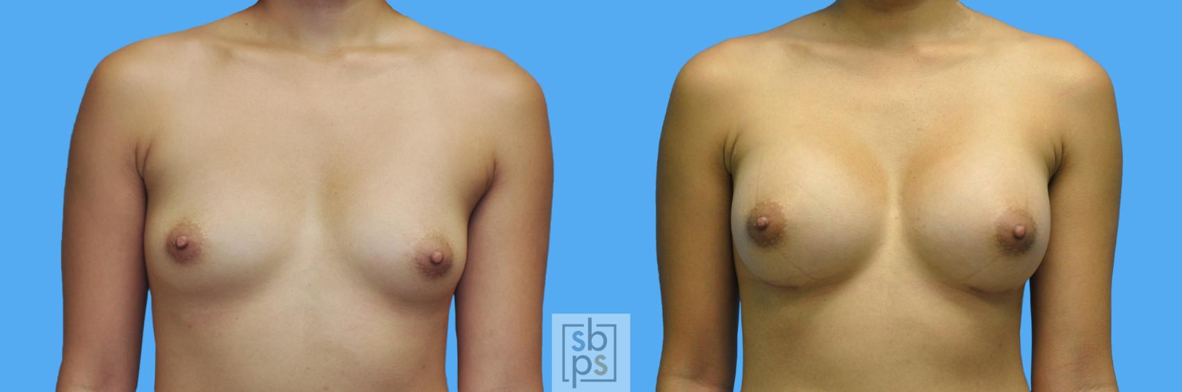 Before & After Breast Augmentation Case 123 View #1 View in Torrance, CA