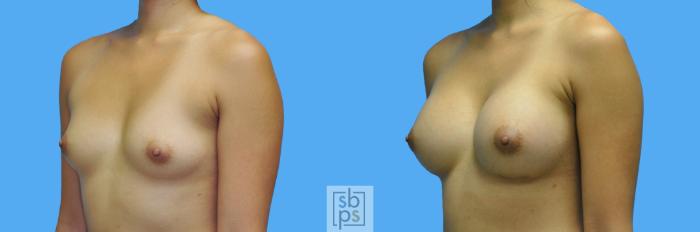 Before & After Breast Augmentation Case 123 View #2 View in Torrance, CA