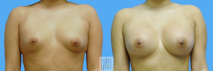 Before & After Breast Augmentation Case 125 View #1 View in Torrance, CA