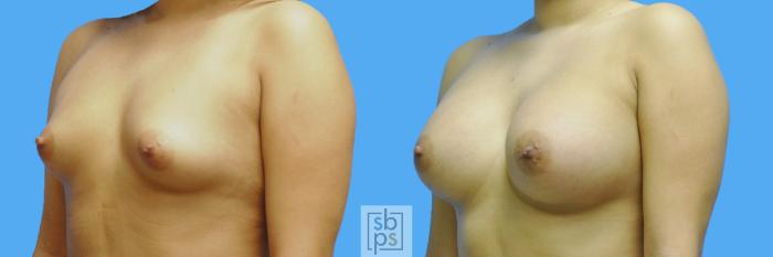 Before & After Breast Augmentation Case 125 View #2 View in Torrance, CA