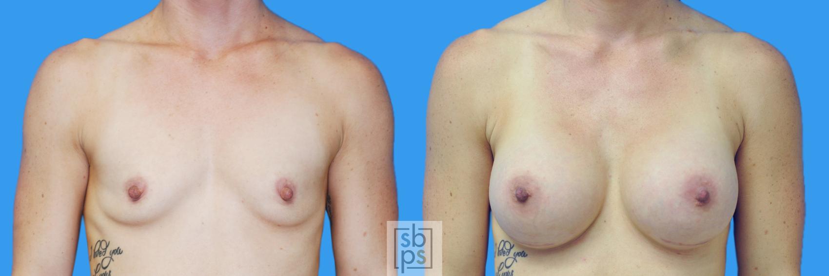Before & After Breast Augmentation Case 126 View #1 View in Torrance, CA