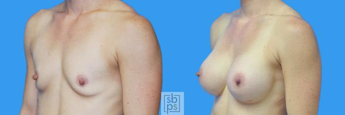 Before & After Breast Augmentation Case 126 View #2 View in Torrance, CA