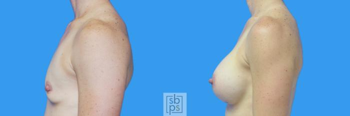 Before & After Breast Augmentation Case 126 View #3 View in Torrance, CA