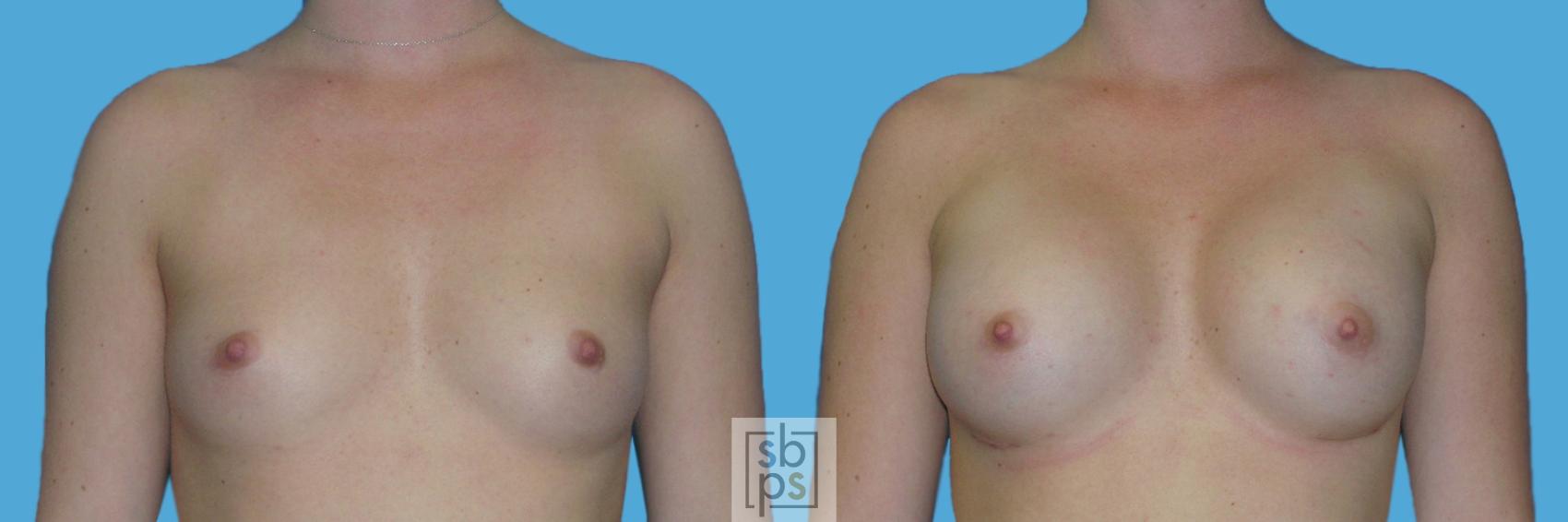 Before & After Breast Augmentation Case 129 View #1 View in Torrance, CA