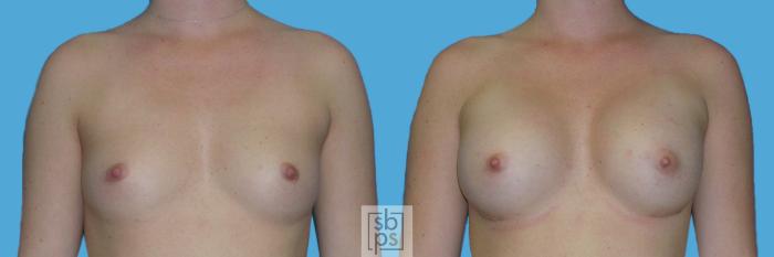 Before & After Breast Augmentation Case 129 View #1 View in Torrance, CA