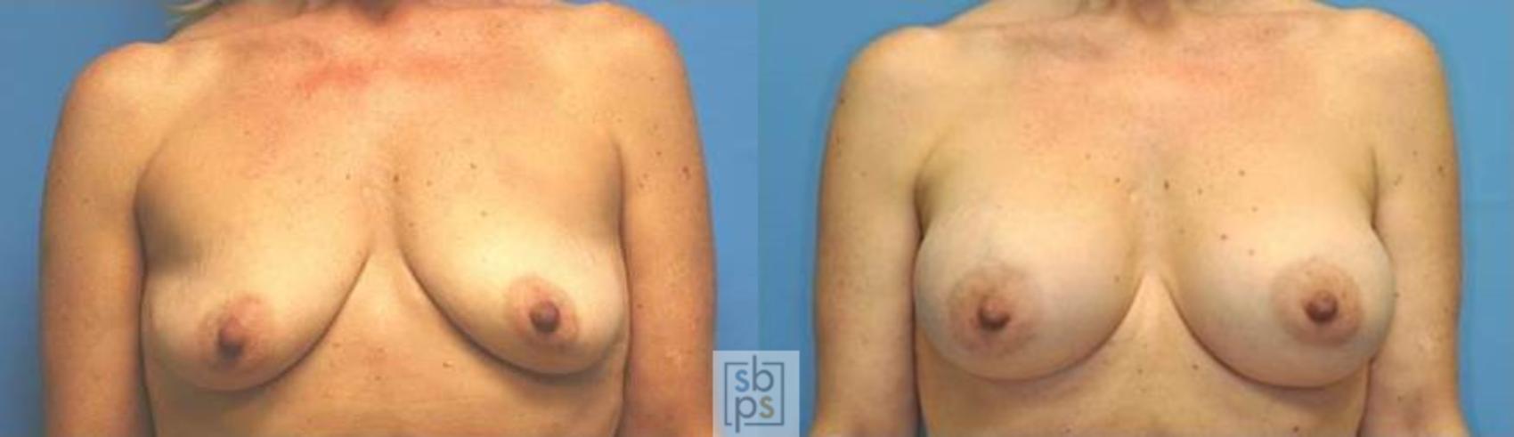 Before & After Breast Augmentation Case 130 View #3 View in Torrance, CA