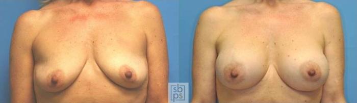 Before & After Breast Augmentation Case 130 View #3 View in Torrance, CA