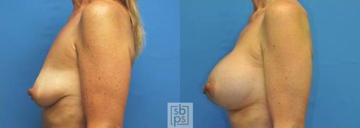 Before & After Breast Augmentation Case 130 View #4 View in Torrance, CA