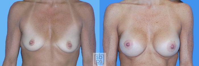 Before & After Breast Augmentation Case 131 View #1 View in Torrance, CA