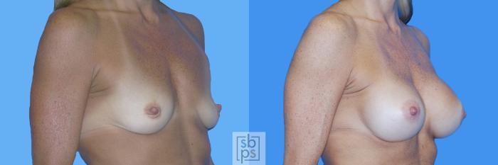 Before & After Breast Augmentation Case 131 View #2 View in Torrance, CA