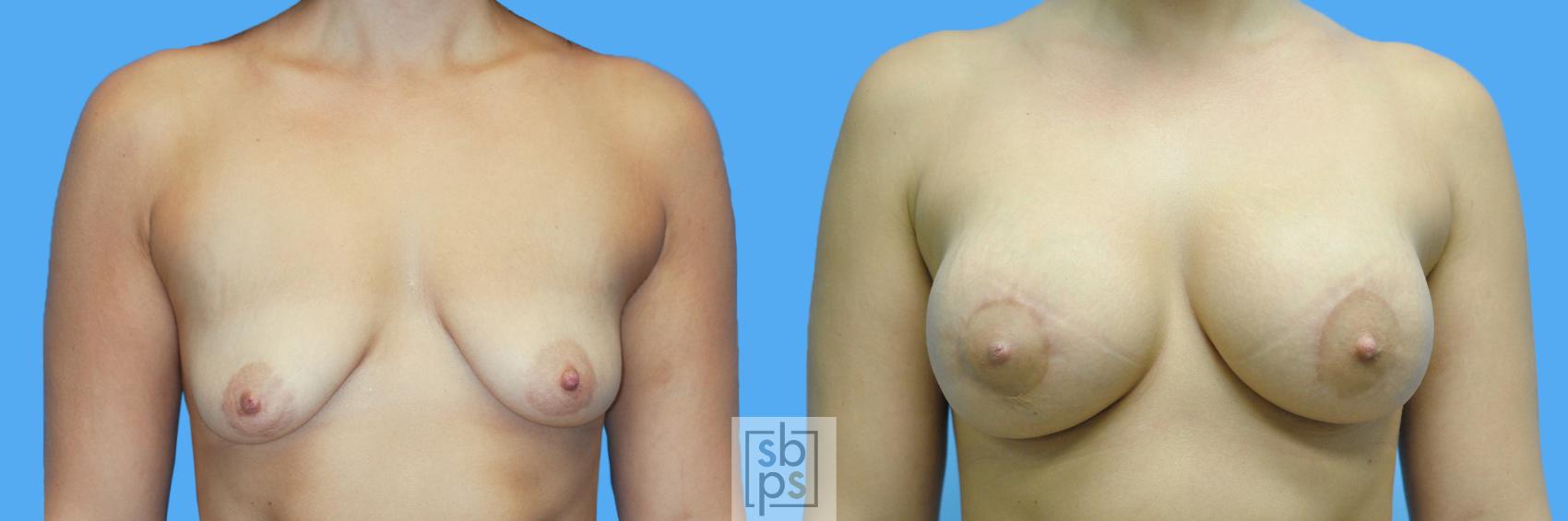 Before & After Breast Augmentation Case 132 View #1 View in Torrance, CA