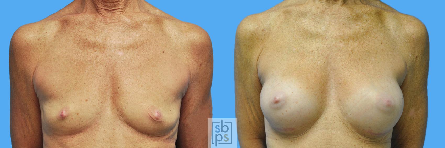 Before & After Breast Augmentation Case 134 View #1 View in Torrance, CA