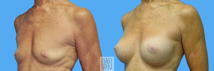Before & After Breast Augmentation Case 134 View #2 View in Torrance, CA