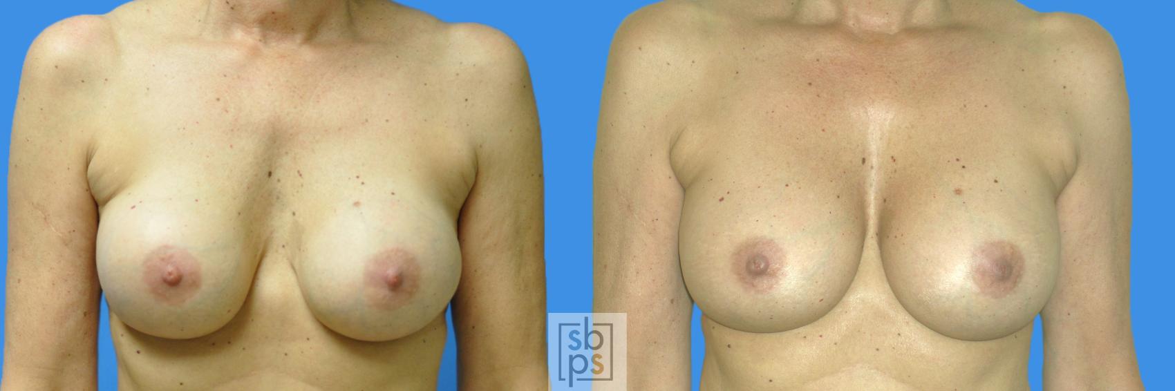 Before & After Breast Augmentation Case 163 View #1 View in Torrance, CA