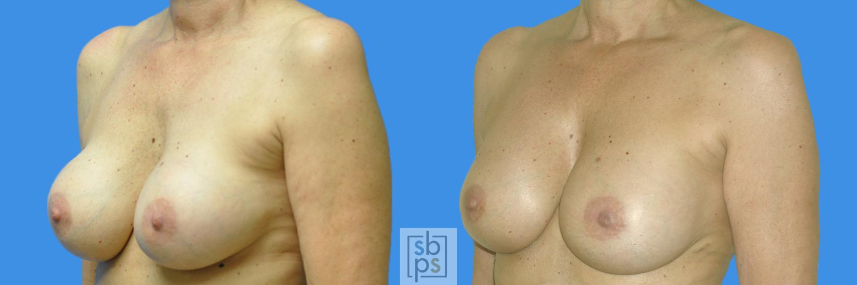 Before & After Breast Augmentation Case 163 View #2 View in Torrance, CA
