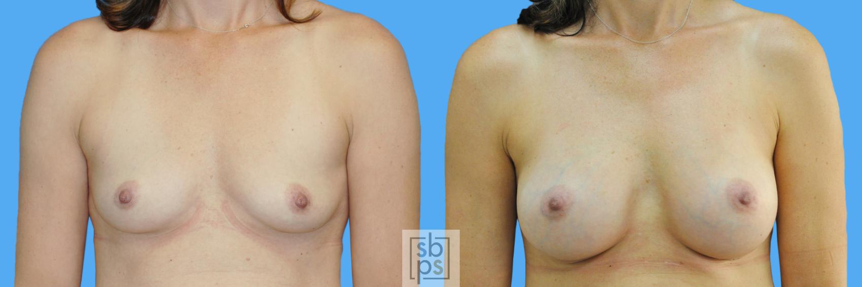 Before & After Breast Augmentation Case 164 View #1 View in Torrance, CA