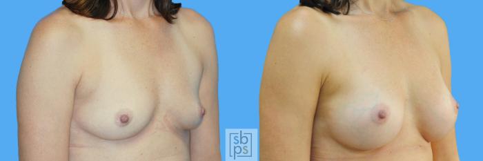 Before & After Breast Augmentation Case 164 View #2 View in Torrance, CA