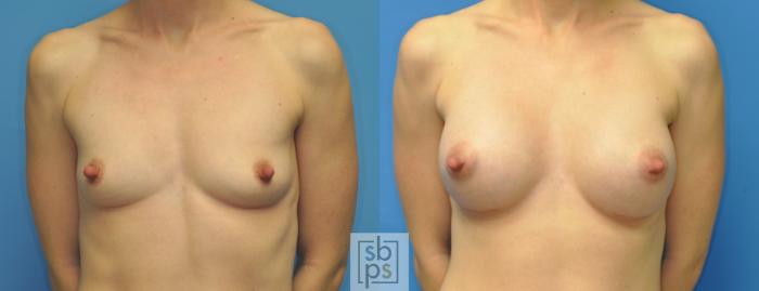 Before & After Breast Augmentation Case 165 View #1 View in Torrance, CA