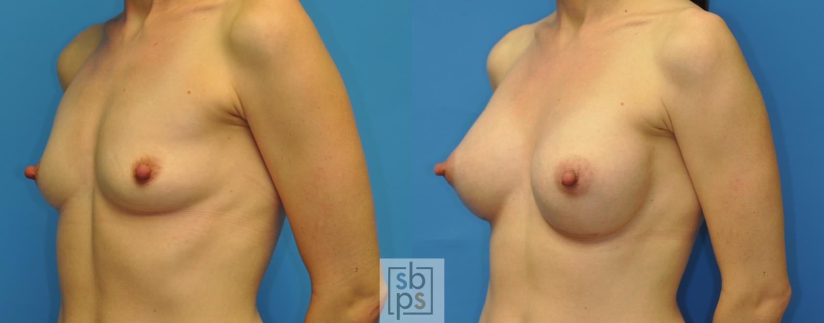 Before & After Breast Augmentation Case 165 View #2 View in Torrance & Los Angeles, CA, CA