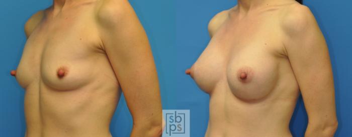 Before & After Breast Augmentation Case 165 View #2 View in Torrance, CA