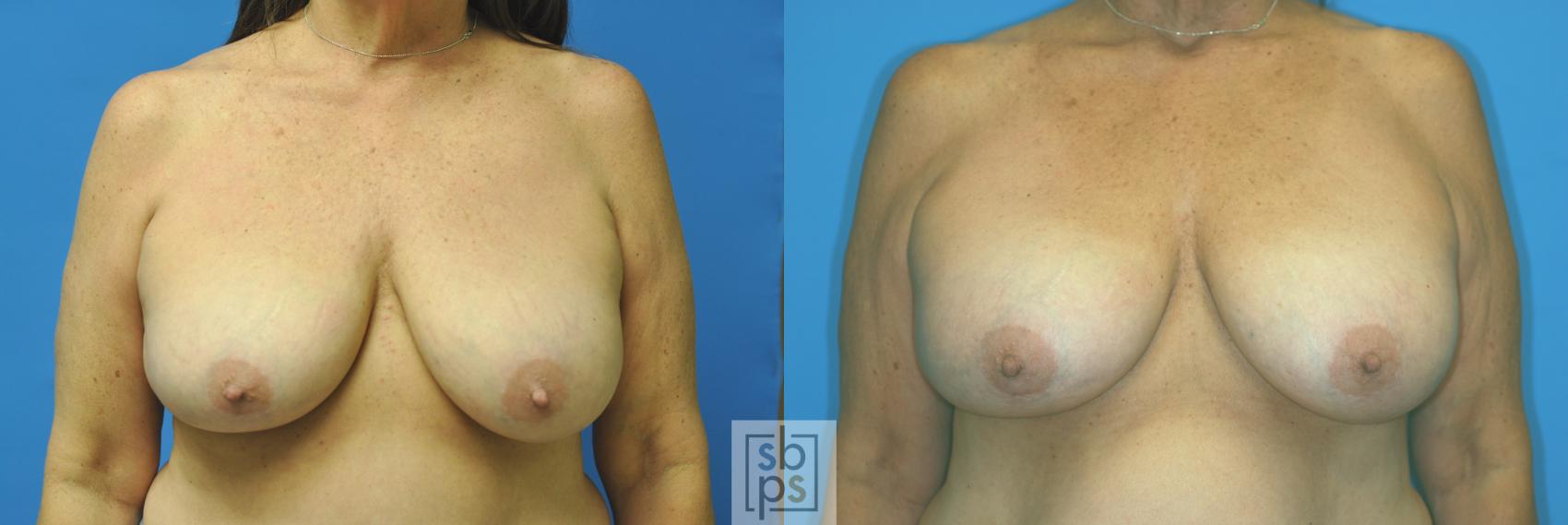 Before & After Breast Augmentation Case 167 View #1 View in Torrance, CA