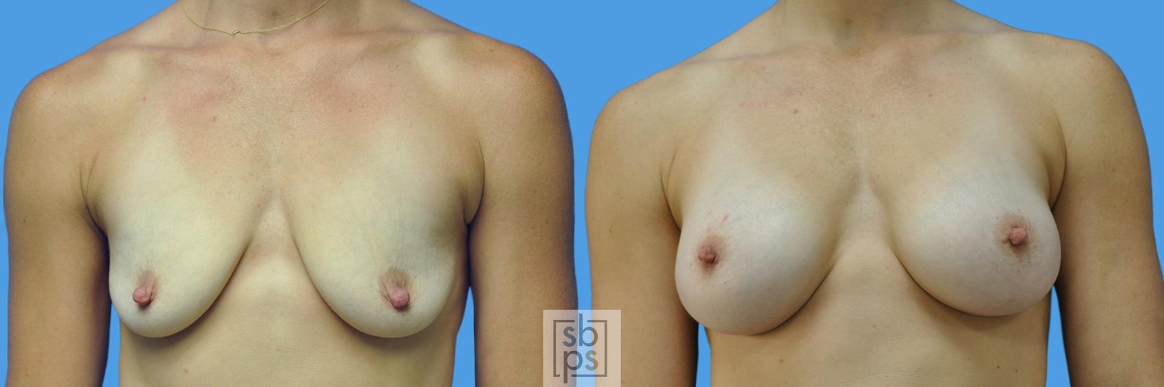 Before & After Breast Augmentation Case 169 View #1 View in Torrance, CA