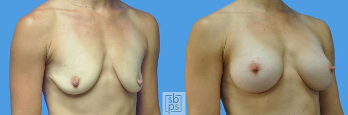 Before & After Breast Augmentation Case 169 View #2 View in Torrance, CA
