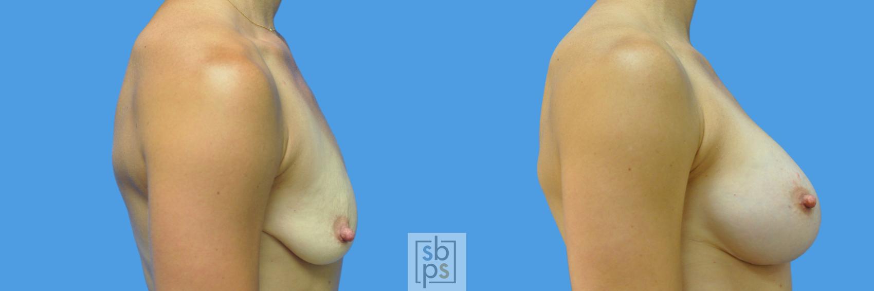 Before & After Breast Augmentation Case 169 View #3 View in Los Angeles, Torrance & Long Beach, CA