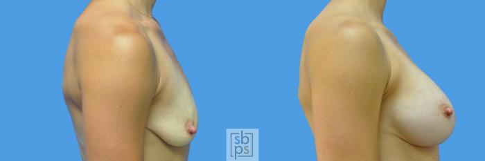 Before & After Breast Augmentation Case 169 View #3 View in Torrance, CA
