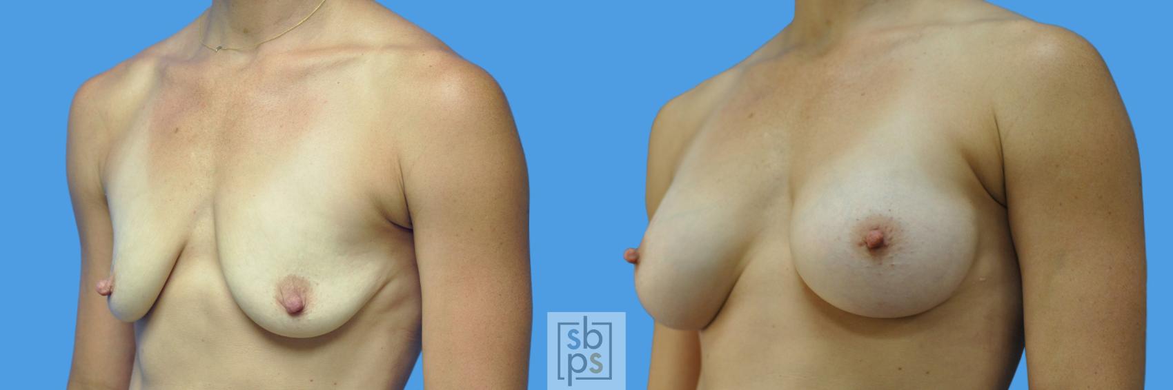 Before & After Breast Augmentation Case 169 View #4 View in Los Angeles, Torrance & Long Beach, CA