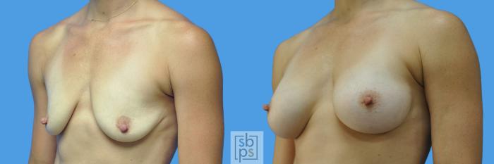 Before & After Breast Augmentation Case 169 View #4 View in Torrance, CA