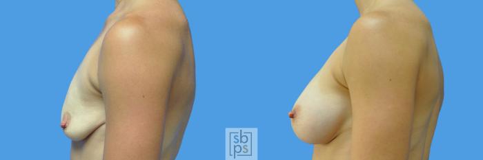 Before & After Breast Augmentation Case 169 View #5 View in Torrance, CA