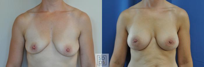 Before & After Breast Augmentation Case 170 View #1 View in Torrance, CA