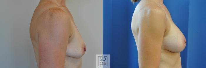 Before & After Breast Augmentation Case 170 View #2 View in Torrance, CA