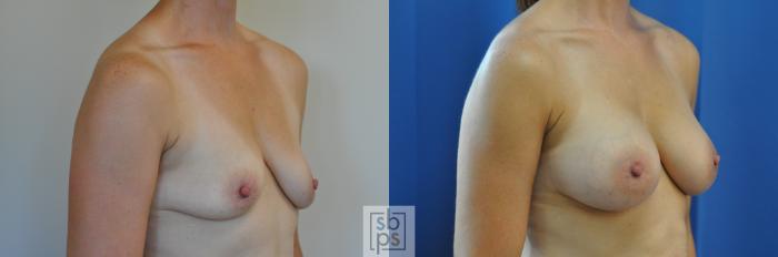 Before & After Breast Augmentation Case 170 View #3 View in Torrance, CA