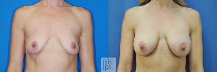 Before & After Breast Augmentation Case 171 View #1 View in Torrance, CA