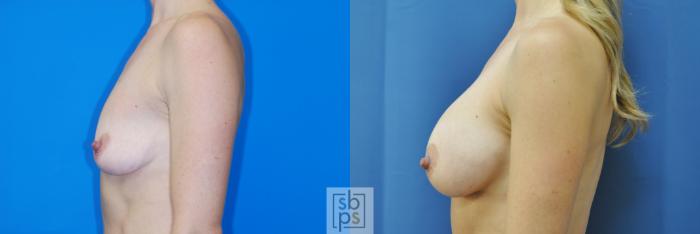 Before & After Breast Augmentation Case 171 View #2 View in Torrance, CA